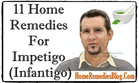 Top 11 Home Remedies To Treat Impetigo Effectively Impetigo Home