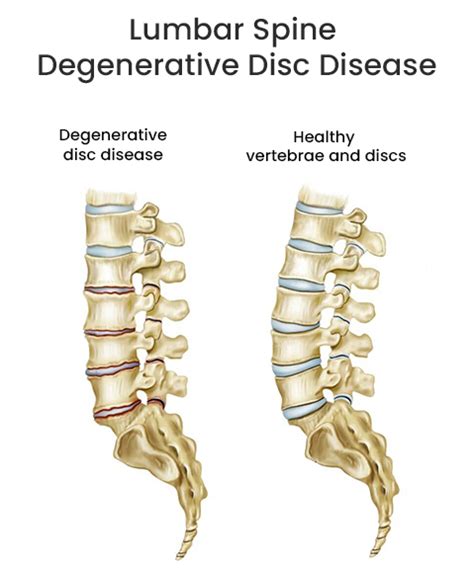 Lumbar Spine Degenerative Disc Diseases Treatment Nj And Nyc