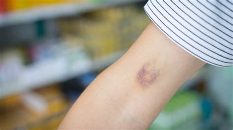 Why Do Some People Bruise More Easily Than Others Bt