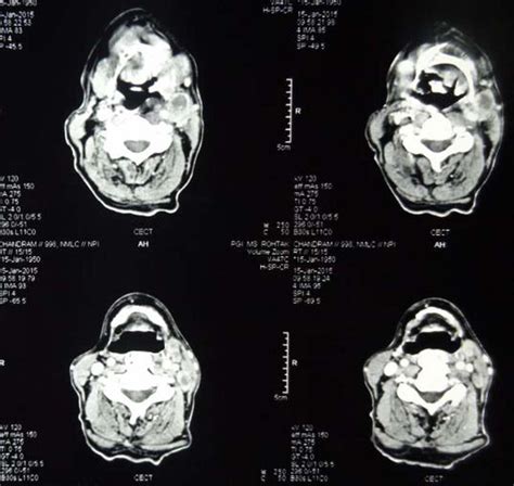 Cect Scan Revealing Multiple Enlarged Necrotic Lymph Nodes In Bilateral