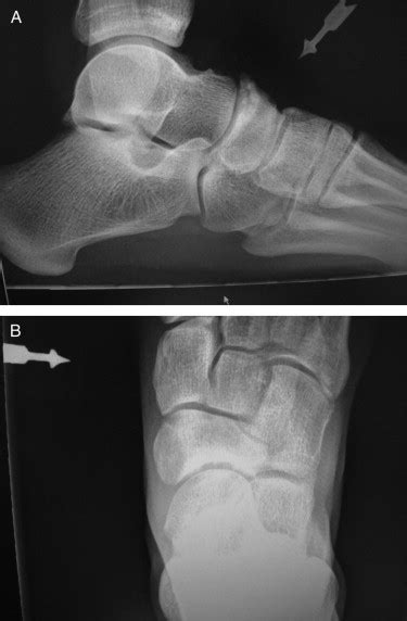 A Unique Procedure For Treatment Of Osteochondral Lesions Of The Tarsal