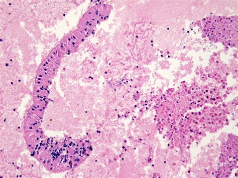 Pathology Outlines Warthin Tumor