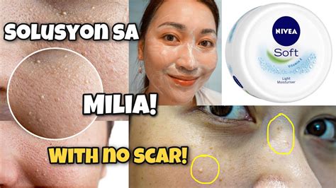 How To Get Rid Of Butlig Sa Mukha