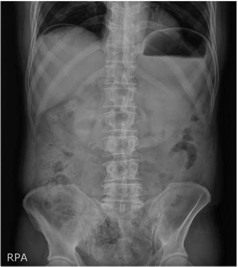 Pre Operative Plain Abdominal X Ray The Image Showing Download