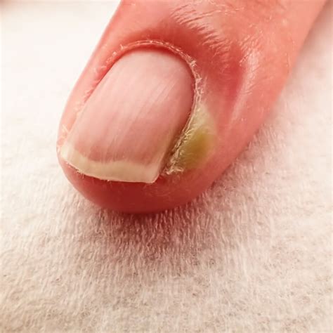 Paronychia Treatment Nail Repair Gel Drs Kline Green™