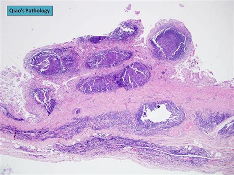 qiao s pathology follicular cholecystitis with lymphoid h… flickr