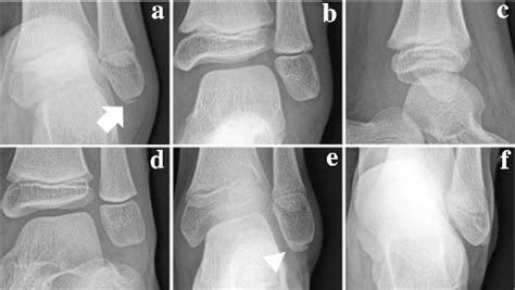 Figure 4 from Avulsion fracture of the distal fibula is ...