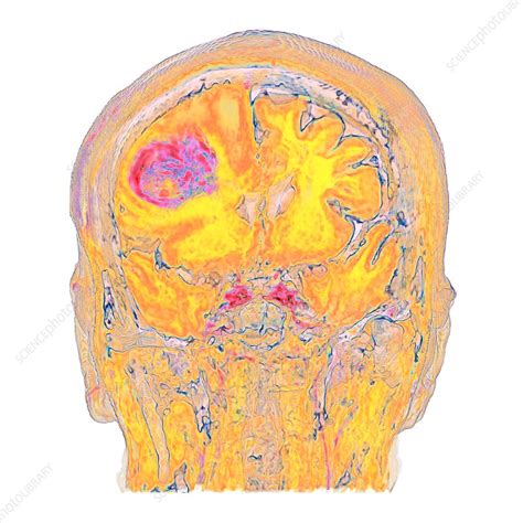 Metastatic Brain Cancer Mri Scan Stock Image C0374649 Science