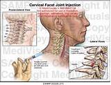 Facet Joint Injection Recovery