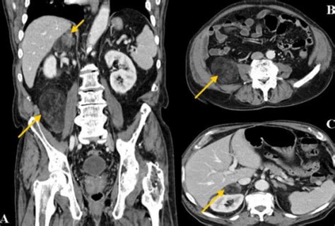 Ct Imaging Of The Abdomen A Coronal Abdominal Ct Scan Open I