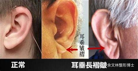 耳垂畸形有哪几种表现？治疗方法有哪些？ 知乎