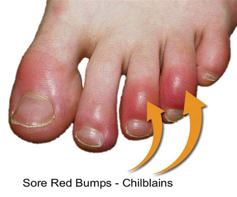 Chilblains On Feet Toes Fir Socks For Toe Chilblains