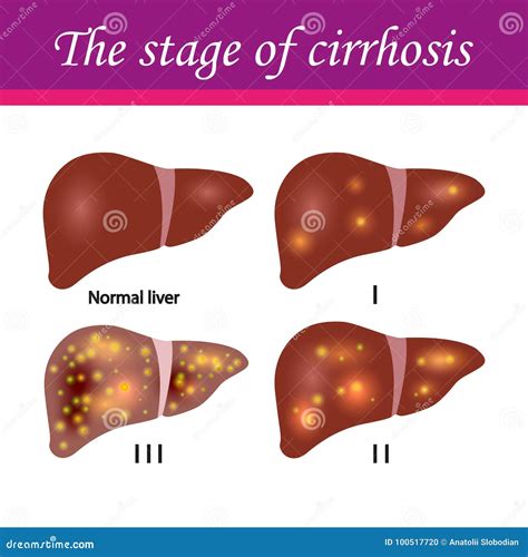 Normal Liver And Liver With Cirrhosis Vector Illustration