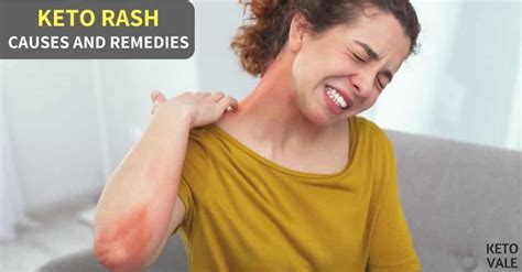 Keto Rash Causes Remedies And How To Prevent