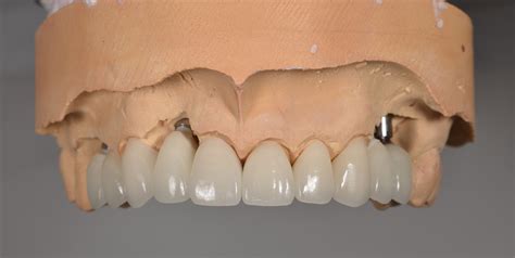 42 Implant Restorations Pindan Dental Laboratory