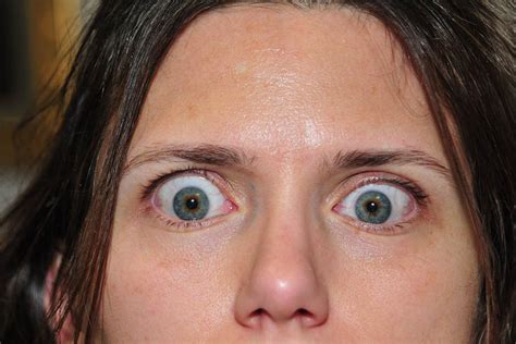 Thyroid Eye Disease And Surgery Morgenstern