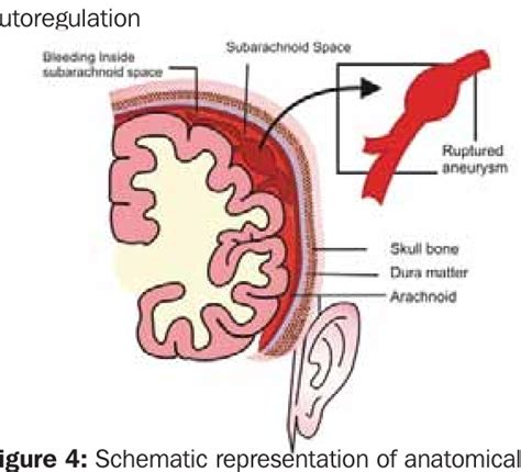 Subarachnoid Hemorrhage Unusual Situations Leading To Sah And