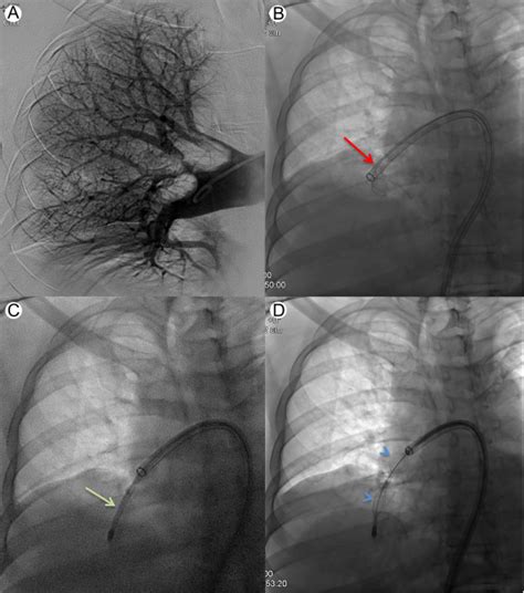 techniques and devices for catheter directed therapy in pulmonary embolism techniques in
