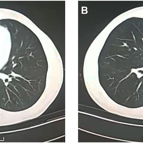 Ct Scan Of The Chest A Chest Computed Tomography Demonstrated A New