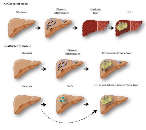 Different Models Of Hepatocellular Carcinoma Development The Canonical