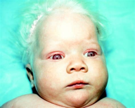 Ocular Albinism Meddic
