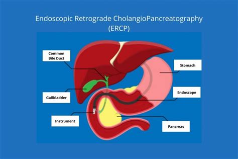 Endoscopic Retrograde Cholangiopancreatography Ercp Procedure