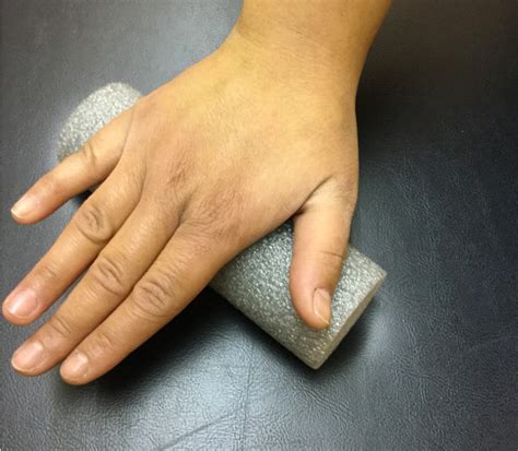 Understanding Dupuytrens Contracture And Its Treatment Ristroller