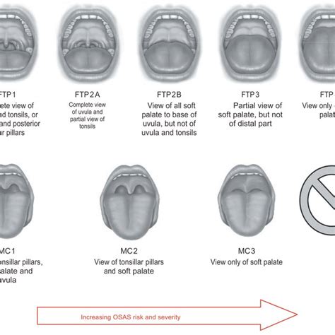 Comparison Of Tongue Position At Rest According To Friedman Friedman