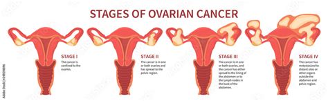 Flat Vector Illustration Of Ovarian Cancer Four Stages Mentioning