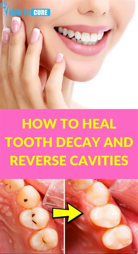 Baby bottle tooth decay occurs in infants and very young children, when liquids whether it is sweetened or with natural sugars baby bottle tooth decay can be reversed or avoided by bringing a few changes to your baby's diet for instance putting a limit. How To Heal Tooth Decay And Reverse Cavities - HowToCure ...