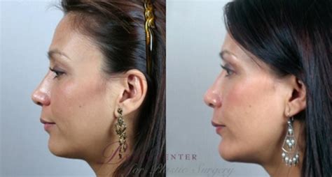 Cheekchin Implants Before And After Pictures Case 891 Paramus Nj