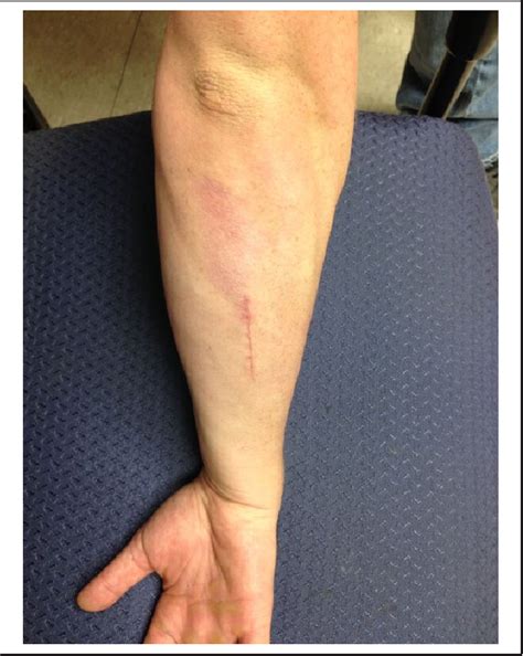 Figure 1 From Endoscopic Fascia Release For Forearm Chronic Exertional