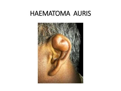 Diseases Of External Ear 1