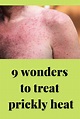 Heat Rash Remedies For Adults