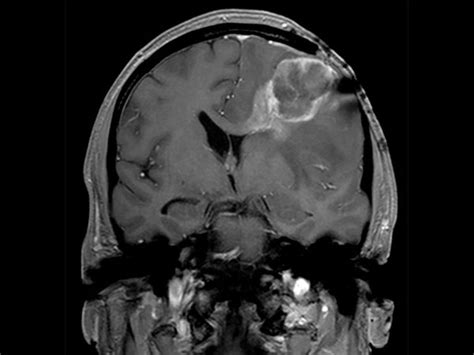 Advanced Brain Imaging Philips Mr Body Map