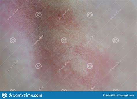 Urticaria On The Skin Red Spots Of An Allergic Reaction On The Skin Of