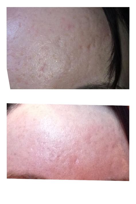 Dermastamp Derma Rolling Results Scar Treatments