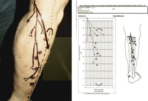 The Sensate Fibula Osteocutaneous Flap Neurosomal Anatomy Journal Of