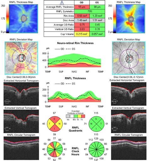 Optical Coherence Tomography Oct Applecross Eye Clinic