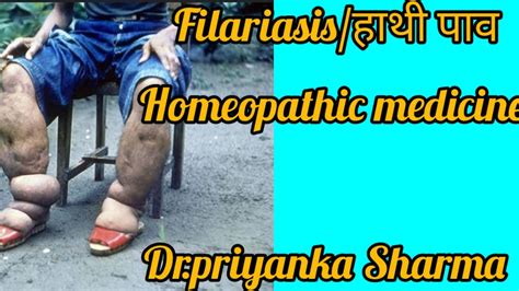 हाथी पांव होम्योपैथिक ट्रीटमेंट Homeopathic Medicine For Elephantiasis And Filariasis Youtube