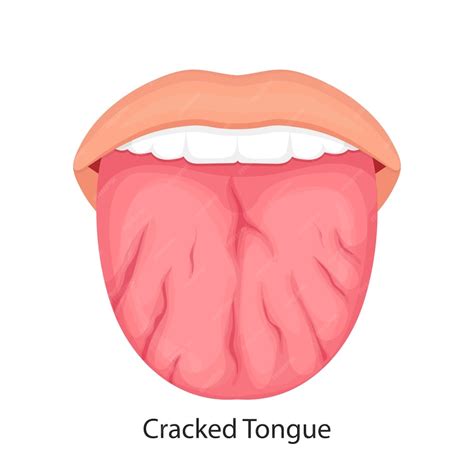 Premium Vector Disease Of The Tongue Cracks Medical Illustration