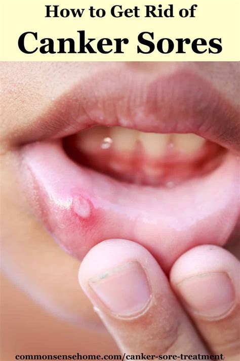 What Can Help Get Rid Of Canker Sores Printable Templates