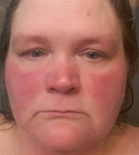 what do you think of this facial redness in my ph lupus uk