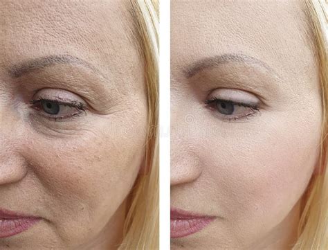 Woman Face Wrinkles Result Removal Difference Before And After
