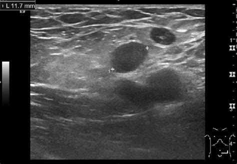 An Inguinal Ultrasound Examination Showed Subcutaneous Edema And