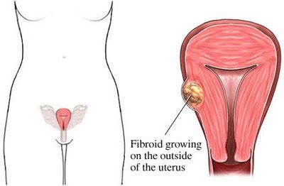 Bagaimana cara mengatasi fibroid rahim? Kesan Makan Ubat Kuatkan Rahim - Berita Jakarta