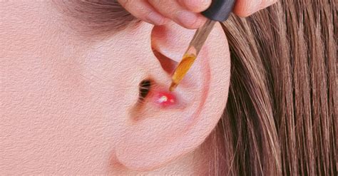 10 Natural Remedies To Banish That Pimple From Your Ear