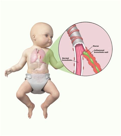 Bronchiolitis In Babies Symptoms Diagnosis And Treatment