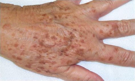 Liver Spots A Sign Of Aging Hyperpigmentation And How To Get Rid Of