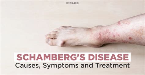 What Is Schambergs Disease